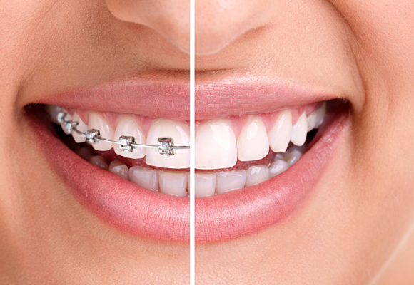 Luce una sonrisa perfecta gracias a productos especiales para ortodoncia